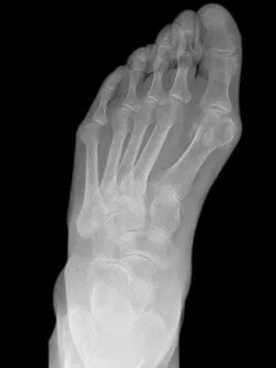 hallux-valgus-op.jpg 